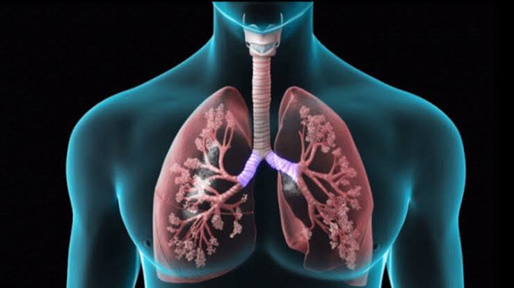 World Lung Cancer Day: Major revelation in KGMU study—over half of the patients suffer from anxiety; mental health highlighted.